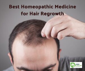 Best Homeopathic Medicine for Hair Regrowth